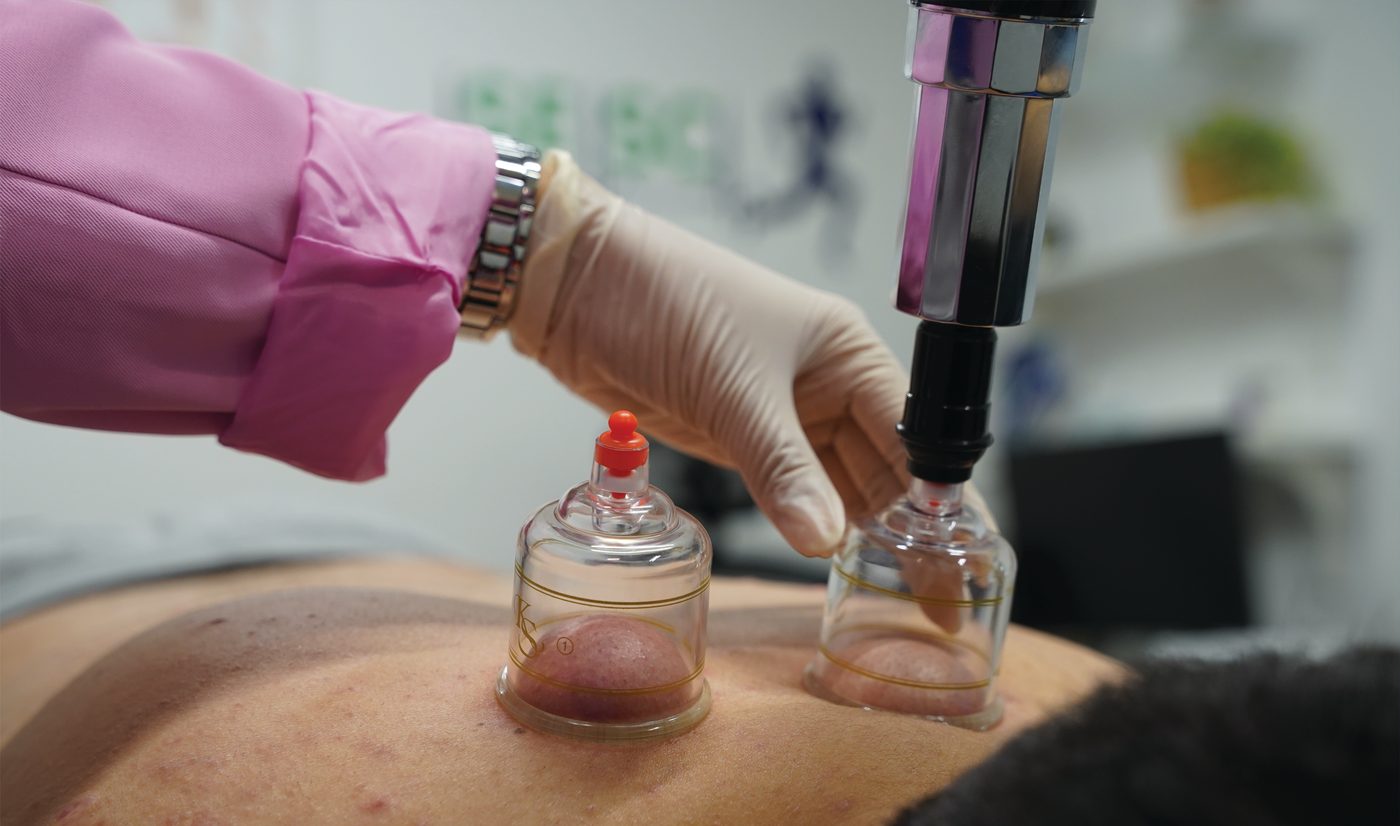 What Is Cupping Therapy?